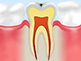 虫歯の状態早見表