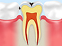 虫歯の状態早見表