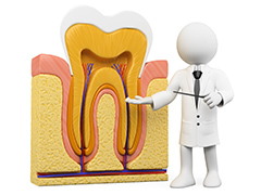 重度の虫歯には根管治療～抜歯しない治療～